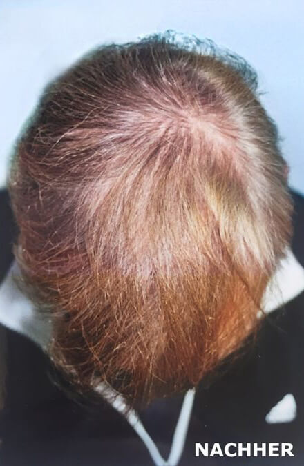 Mann nach der Haartransplantation