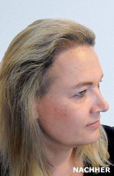 Frau nach Haartransplantation