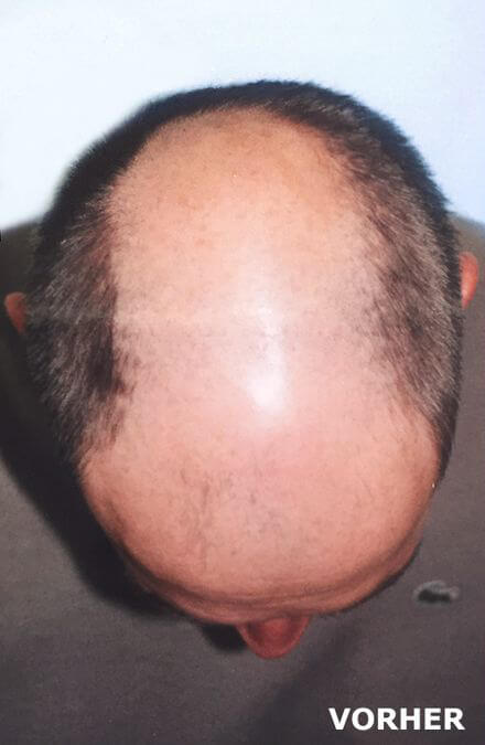 Mann von der Haartransplantation