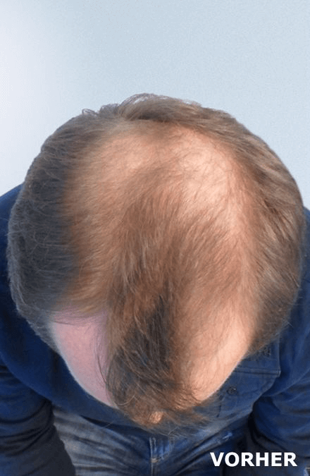 Mann vor der Haartransplantation