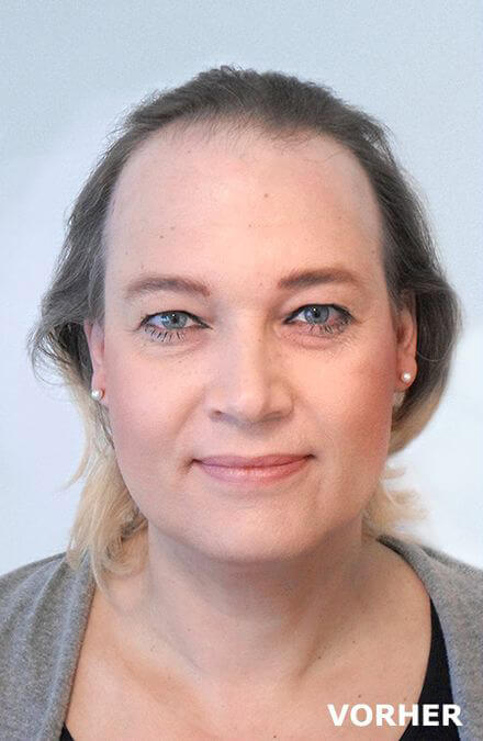 Frau vor Haartransplantation