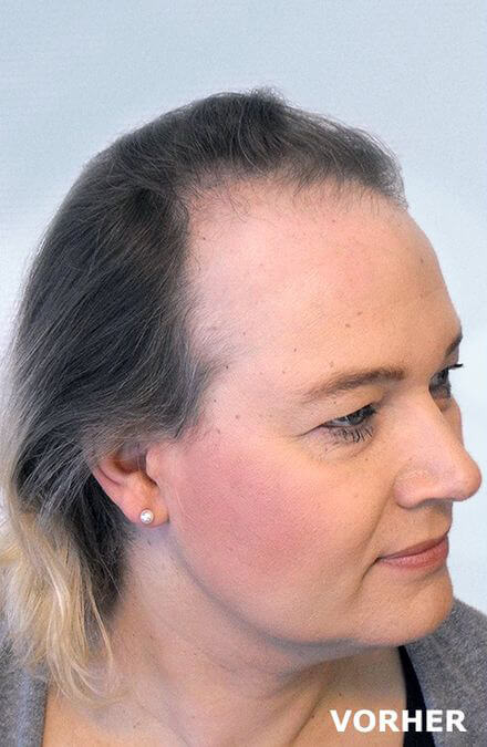 Frau vor Haartransplantation